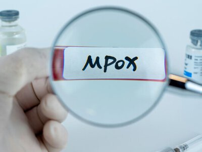 Вірус mpox в Україні: як передається інфекція, які симптоми та правила безпеки - Simya