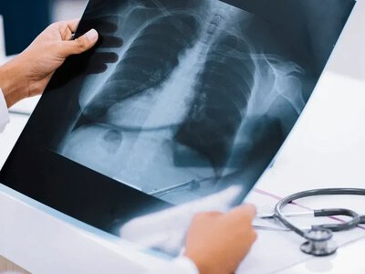 Мешканці п’яти громад Херсонщини зможуть безплатно зробити рентген