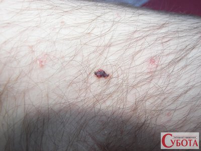 Червоні крапки на шкірі: що таке вишневі ангіоми і коли їх варто показати лікарю