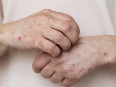 Як перевіритись на сифіліс: аналіз РМП, симптоми та розшифровка результатів