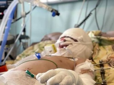 Бельгія виділить 10 мільйонів євро в розвиток системи допомоги при опіках в Україні