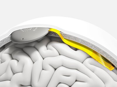  Американська Precision Neuroscience залучила $250 млн на технології зв’язку мозку з комп’ютером 