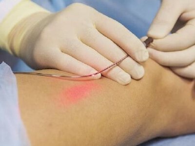 Лазерне видалення вен: як діє сучасна медицина в клініці “Ангіолайт”