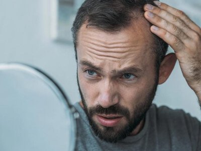 Чому чоловіки лисіють: біологічні та еволюційні причини