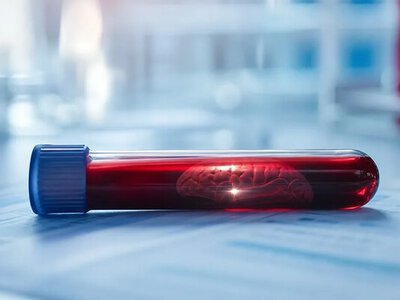 Крайні рівні гемоглобіну пов’язали з вищим ризиком деменції — News-Medical
