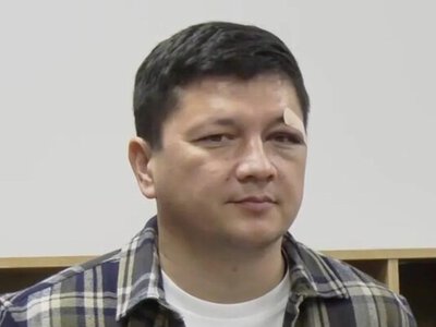 Фото: Віталій Кім з’явився на публіці із синцем і набряком біля ока
