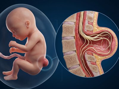 Причини виникнення Spina Bifida, роль профілактики під час планування вагітності